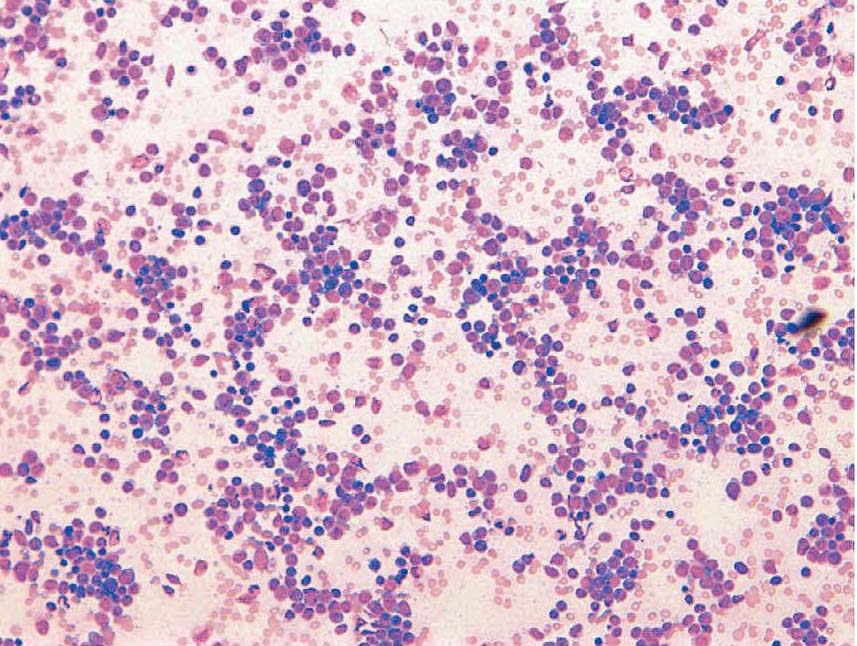急性淋巴细胞白血病-L2型